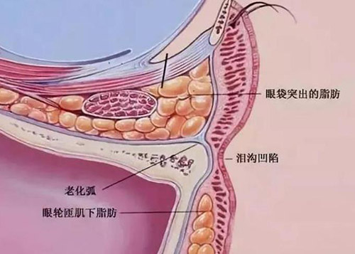 祛眼袋术后注意事项