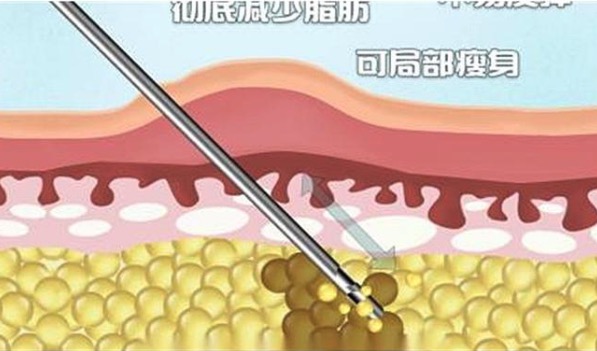 目前成果较好的抽脂方式有哪些