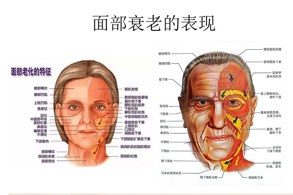 小拉皮手术可以去泪沟和法令纹吗