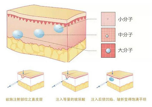 玻尿酸填充的缺点