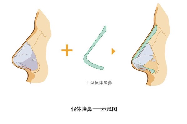 假体隆鼻三年鼻梁中间发红怎么办？