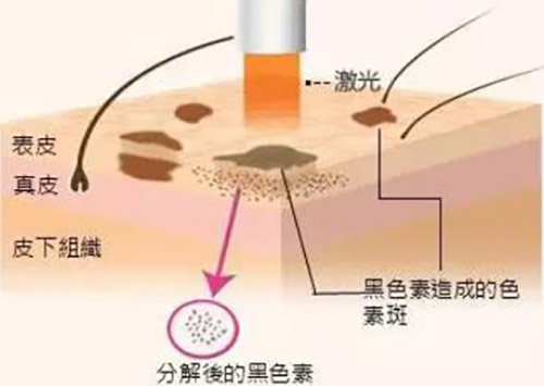 激光祛斑后注意事项有哪些