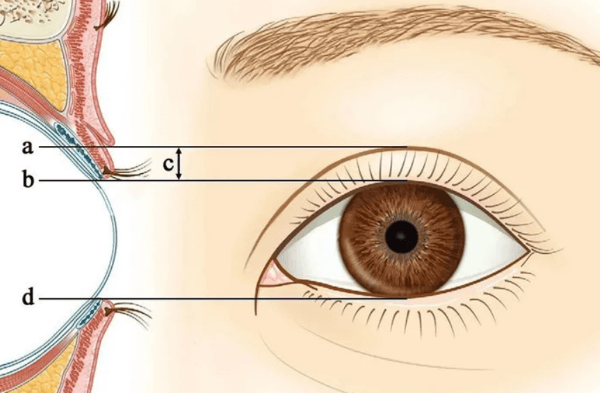 双眼皮正常距离
