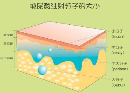 玻尿酸填充泪沟好吗