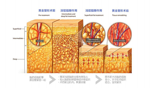 黄金微雕的功效和作用