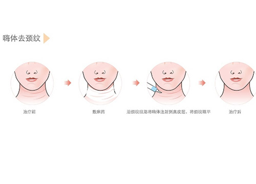 嗨体去颈纹过程