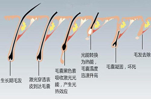 激光脱毛和冰点脱毛有什么区别