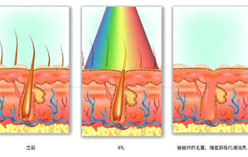 激光脱毛的危害有哪些