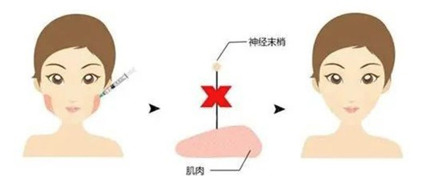 下颌缘提升怎么打