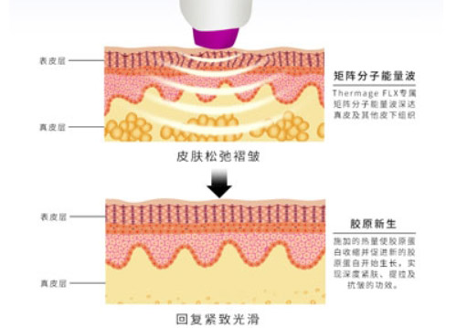 热玛吉四代和五代的区别