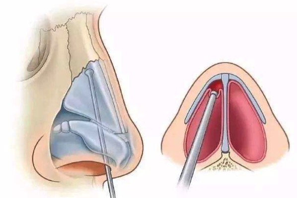 鼻综合包括哪些项目大概要多少钱？