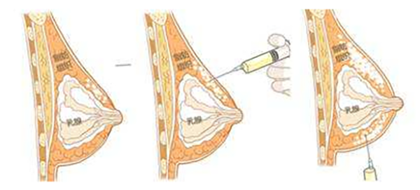 玻尿酸丰胸怎么操作