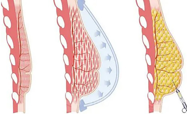 玻尿酸丰胸怎么操作