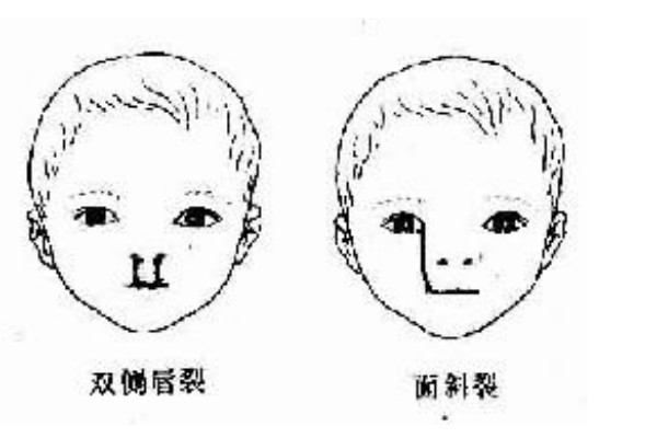 华西罗恩医生面裂手术