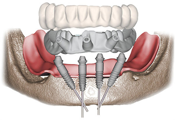 all-on-4种植牙