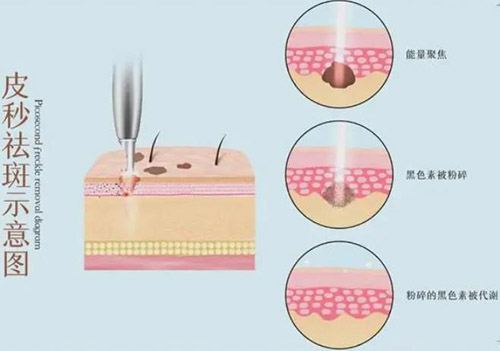 皮秒祛斑的好处与弊端是什么