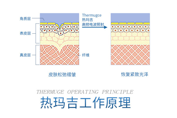 热玛吉的工作原理