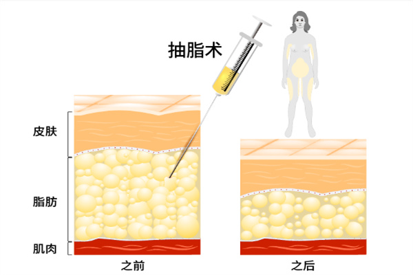 手术吸脂原理