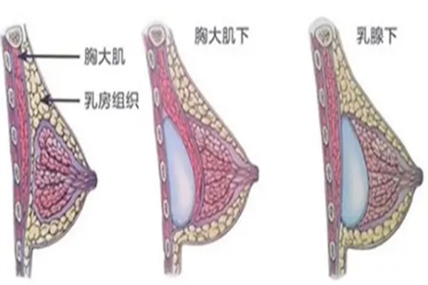 假体胸植入