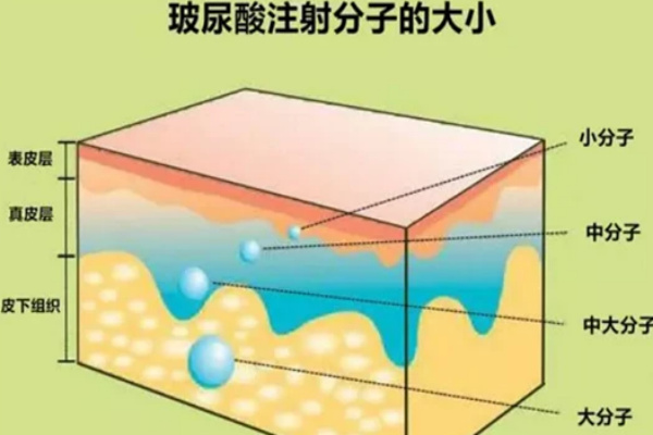 玻尿酸注射抗衰