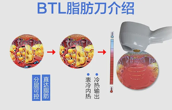 btl射频溶脂原理