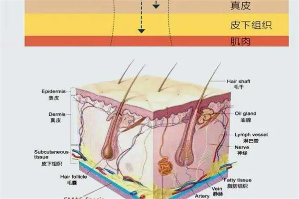 光子嫩肤深层改善皮肤问题