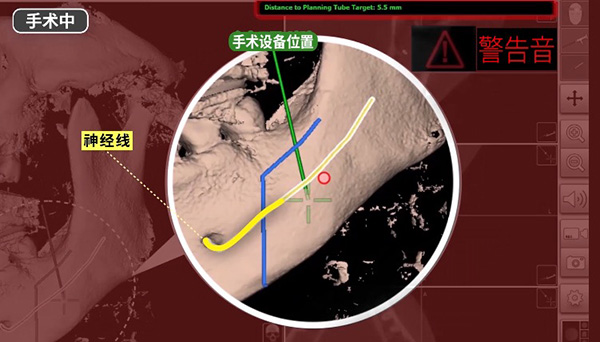 韩国id整形医院双鄂手术怎么样？导航&无捆绑双鄂手术先进技术好