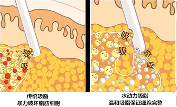 李英杰超脂塑绝代双雕技术优势