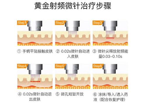 黄金微针的操作过程