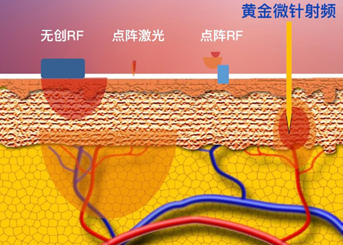 黄金微针多久看到疗效