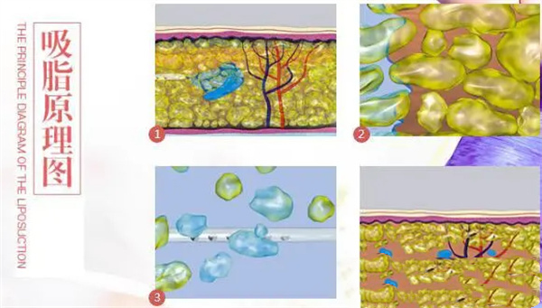 吸脂原理