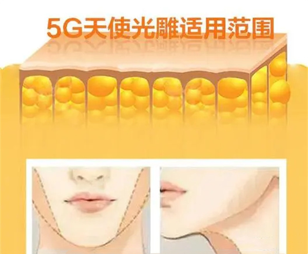 5g天使光雕