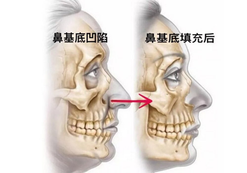 鼻基底凹陷图片