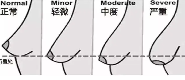 乳房下垂程度