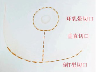 乳房下垂棒棒糖法