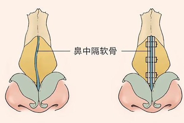 谁知道歪鼻矫正大概多少钱