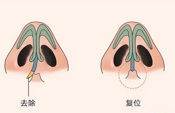 谁知道歪鼻矫正大概多少钱