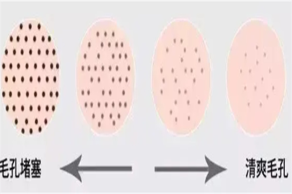 毛孔衰老程度表