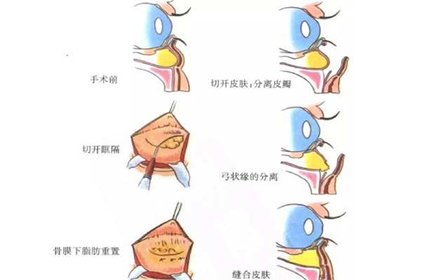 眶隔释放流程图