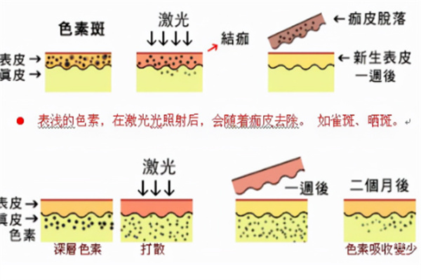 皮秒祛斑操作流程