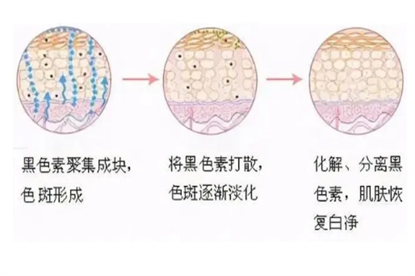 皮肤祛斑流程