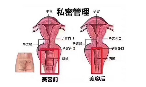 3d生物束带紧缩术和传统的有什么不一样？话说3d生物束带能缩到几指