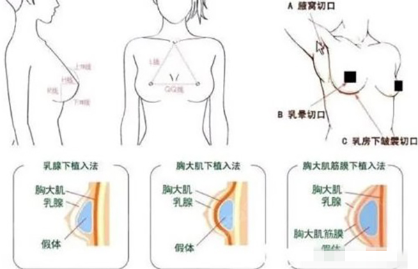 李高峰隆胸手术做得怎么样