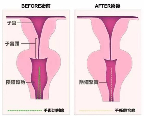 3d生物束带紧缩术