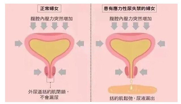 3d生物束带紧缩术