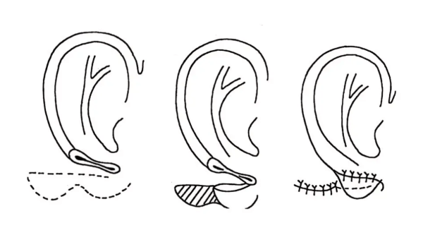 耳畸形整形手术