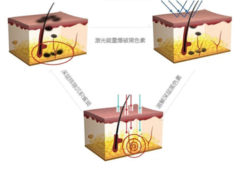 太田痣的治疗方法是什么