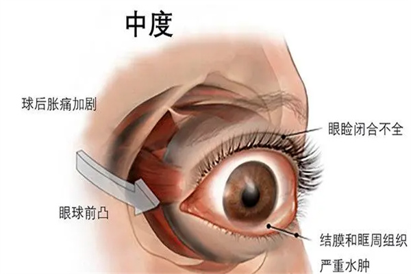 眼睑退缩手术矫正