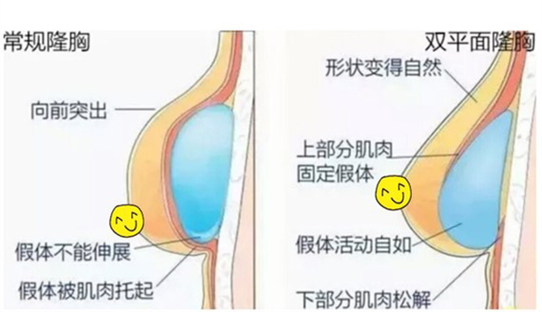 双平面隆胸技术