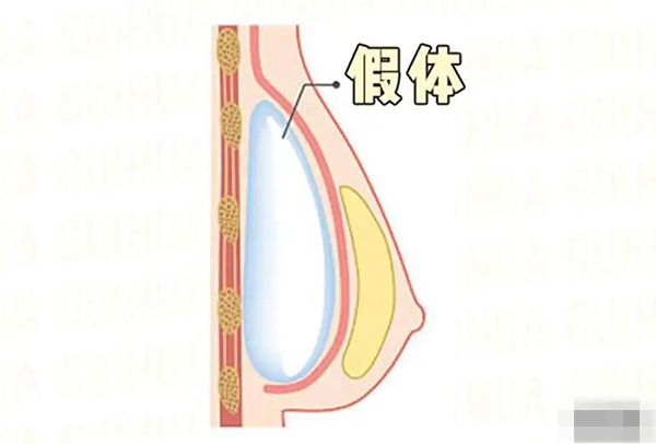 双平面隆胸是什么意思